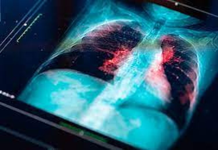Genetics of nearby healthy tissue may help detect lung cancer's return: Study