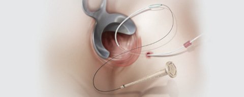 NICE Recommends Bioprosthetic Plug for Anal Fistulas